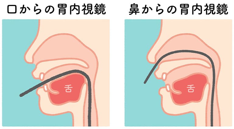 経口・経鼻内視鏡検査の違い